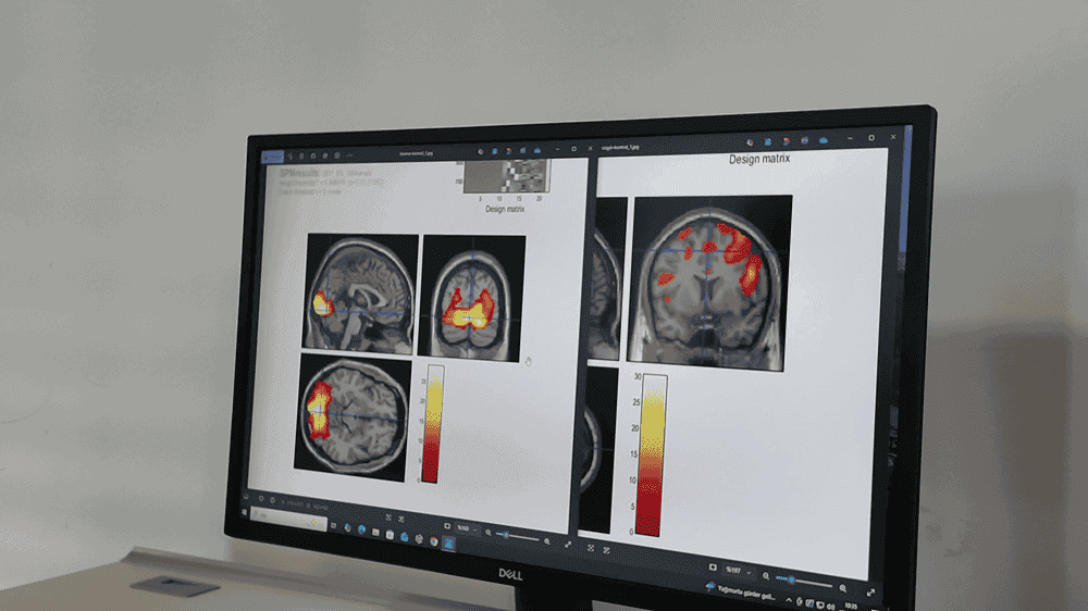 NÖROM Araştırması: Migrenli Beyin Görsel Uyaranları Filtreleyemiyor ve Ağrı Mekanizmasını Tetikliyor